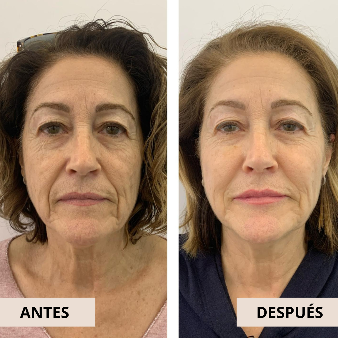 DIVINE™ Luxury Skincare Efecto BOTOX | Rostro perfecto en 2 semanas - 100% GARANTIZADO